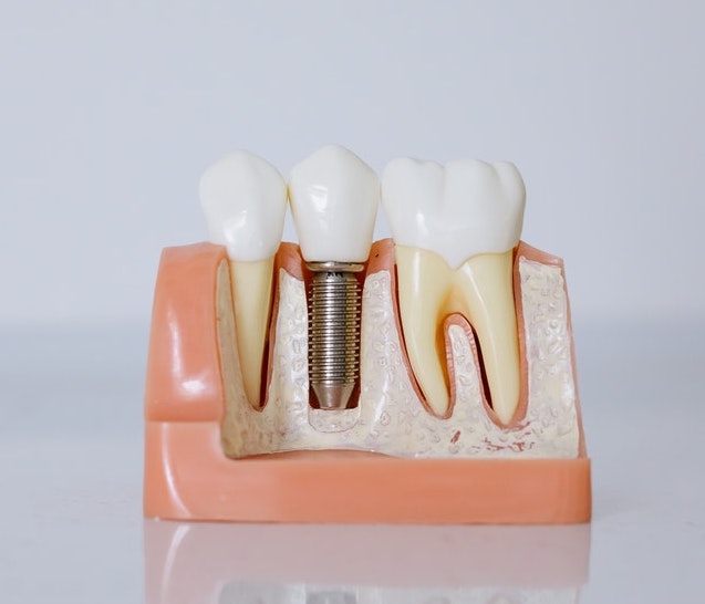 zubni implanti<p dir=ltrKada se razmatraju zubni implanti cena jednog zuba je dosta viša nego što je to slučaj kod mosta ili proteze. Pa ipak, prednosti ovih veštačkih zuba je velika i svakako je isplativo postaviti ih jer donose i zdravstvene i estetske prednosti.<p dir=ltrKakvu prednost donose zubni implantati? Šta kažu iskustva pacijenata? Isplatili se čekati od 4 do 6 meseci na završavanje procedure ugradnje?<p dir=ltrDozvolite da vam predočimo sve prednosti implanta za zube i zašto je dobro platiti skoro 300 € za jedan zub.<p dir=ltr<br<h2 dir=ltrZdravstvene prednosti zubnih implantata</h2<p dir=ltr<a href=https://www.ordinacijavukovic.rs/page/implantologija/Zubni implantati</a su zdravstveno najbolje rešenje za nedostajući zub. Reč je o protetičkom rešenju koje ima i veštački koren i veštačku krunicu pa možemo reći da u potpunosti zamenjuje izvađen zub.<p dir=ltrNi jedno drugo rešenje ne može da nadoknadi koren što je jako važno da bi mogla da se sačuva dobra funkcija vilice, naročito ako nedostaje više zuba. Desni se povlače na tom mestu i gubi se normalna funkcija žvakanja. To uzrokuje da se opterećuju drugi zubi i druga strana vilice pa će ti zubi biti u većem problemu i pokvariti se brže.<p dir=ltrJasno je zašto su zubni implanti cena viših od svih drugih procedura, jednostavno je postupak takav da iziskuje postepen proces ugradnje, prvo korena pa onda i krune zuba.<p dir=ltr<br<h2 dir=ltrDug proces ugradnje – dugo trajanje implantata</h2<p dir=ltrJedan od razloga zašto su zubni implanti cena koje se kreću po nekoliko stotina evra je i zato što se ugrađuje titanijumski koren koji vredi puno. Čvrst je, stabilan i kompatibilan sa ljudskim tkivom pa će se ponašati kao koren prirodnog zuba.<p dir=ltrNjegova ugradnja može da se radi odmah po vađenju prirodnog zuba, ali i kada prođe neko vreme. Hirurški se postavlja veštački koren u vilicu i čeka se između 4 i 6 meseci da on sraste. Za to vreme se nosi privremena krunica i prati zarastanje od strane stomatologa.<p dir=ltrKada se proceni da je koren dobro fiksiran sledi stavljanje veštačke krunice koja je još jedan razlog zbog čega su cene zubnih implantata visoke. Naime, ona se pravi od kvalitetne podloge sa keramičkim premazom pa može da istrpi veliku silu zagrižaja i čvrsta je isto kao i prirodan zub.<p dir=ltrKada se ceo proces završi, implantat verno imitira zub od korena do krune, traje duže nego ostala protetička sredstva i čuva i desni.<p dir=ltr<br<h2 dir=ltrEstetske prednosti ugradnje</h2<p dir=ltrKada nedostaje <a href=https://sh.wikipedia.org/wiki/Zubizub u vilici</a i desni se povuku, a to se jasno ocrtava na licu, obrazi upadaju i menja se kompletan izgled.<p dir=ltrMost i totalna proteza popunjavaju zubni niz, ali ne utiču na desni koje nastavljaju da se povlače. To povlačenje uzrokuje pa se proteze moraju korigovati nakon nekog vremena. Pri tome, most se kači na zdrave zube pa i oni propadaju dok je totalna proteza jednostavno teška za privikavanje.<p dir=ltrTek kada se postave zubni implanti vidi se pun efekat, naročito ako postoji nekoliko zuba koji nedostaju u nizu. Pravilnim popunjavanjem dobija se trajna zamena u vilici pa je jasnije koliko vrede ovakva protetička rešenja i zašto je, kada su u pitanju zubni implanti cena visoka.<p<br